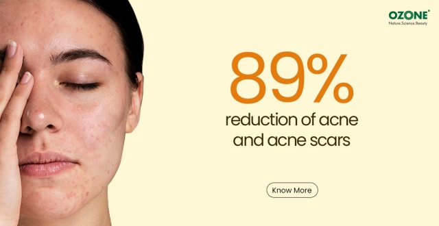 How Acne Check Face Wash Helps Prevent Breakouts