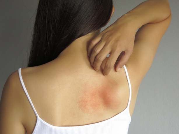 Hives Treatment in Islamabad: Should You See a Doctor?