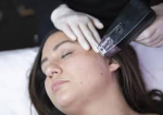 Best 7 Morpheus8 Treatments Near Me