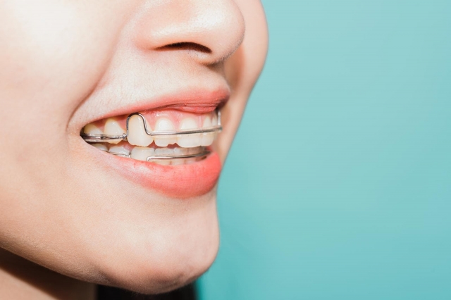 A Complete Guide to Choosing Your Retainer