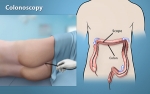 Colonoscopy Cost in India – A Comprehensive Guide