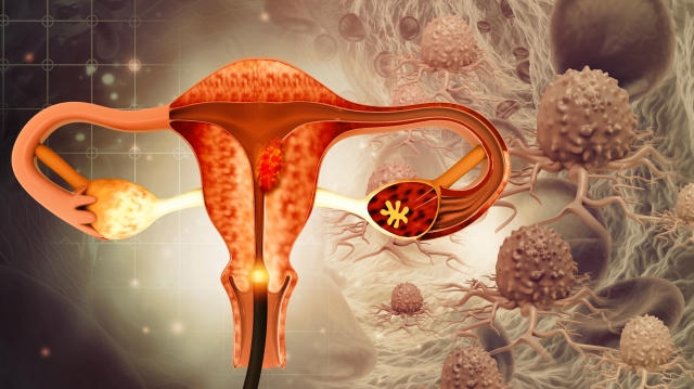 7 Ovarian Cancer Symptoms You Must Not Ignore