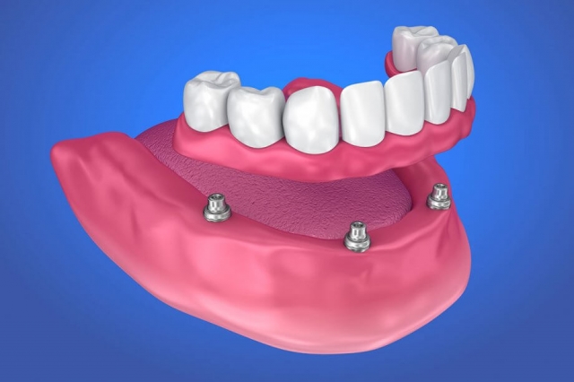 From Impressions to Perfect Fit: The Process of Getting Dentures