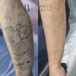 The Science Behind Laser Tattoo Removal: How Does It Break Down Ink?