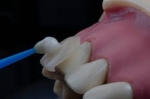 Everything You Need to Know About E-Max Veneers