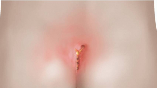 Pilonidal Sinus Treatment: How Laser Therapy Can Help?