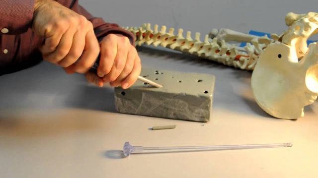 Bone Graft Harvester: A New Tool to Help Orthopedic Surgeons in Bone Graft Procedures