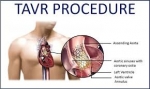 Choosing TAVI Surgery in Delhi: A Heartfelt Step Towards Better Health