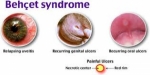 Behcet’s Syndrome Market Size, Demand And Future Scope Report 2030