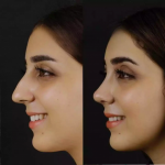 How Long Does Surgery Take with the Best Septoplasty Surgeons in Dubai?
