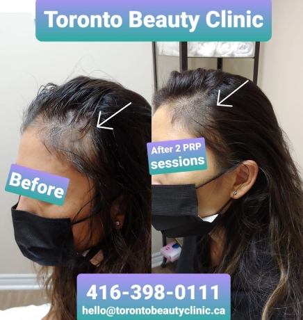 Stop Hair Loss Now: Hair Treatment For Receding Hairline That Deliver Results