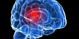 Brain Tumor Diagnosis & Therapeutics Market: Dominant Region and Emerging Trends