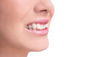 Transform Your Smile, Treating Overlapping Teeth