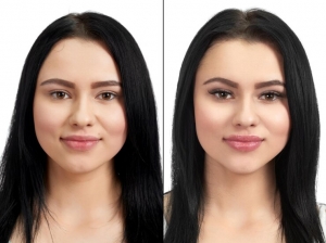 Before and After Buccal Fat Removal: What to Expect