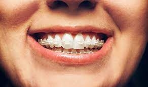 Metal Braces, A Reliable Path to a Beautiful Smile