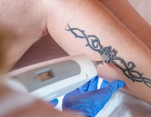 Laser Tattoo Removal Revolution – The Future is Here!
