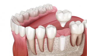 Zirconia Dental Implants: The Strong and Aesthetic Choice for Tooth Replacement