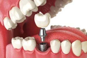 Can inserting dental implants be a painful process?