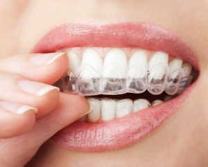 How Retainers Help Prevent Teeth Shifting After Orthodontic Treatment