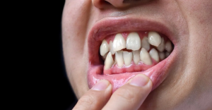 Crowded Teeth Solutions for a Straighter Smile