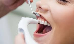 Perfect Your Smile with Professional Teeth Cleaning