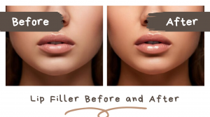 Lip Filler Before and After