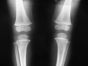 The Future of X-linked Hypophosphatemia Therapeutics Market is Bright Owing to Growing Pipeline Drugs