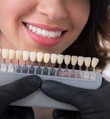 Composite Veneers vs. Porcelain, Which Is Better?