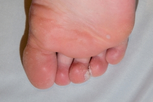 Plantar Warts Between Toes: What You Need To Know