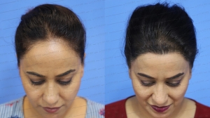 Hair Transplant on a Budget: How to Save Money Without Compromising Quality