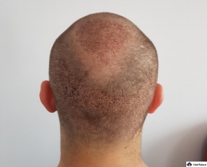 Achieve the Perfect Hairline with Expert Hair Transplant Solutions