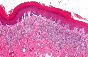 Lichen Planus Treatment Market is Estimated to Witness High Growth Owing to Advancements in Biologics Drugs