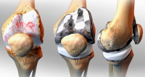 The Prosthetic Joint Infection Market will grow at highest pace owing to rising geriatric population 