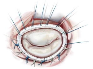 Mitral Valve Annuloplasty Rings Market Growth to be driven by Advancements in Transcatheter Mitral Valve Repair Technologies 