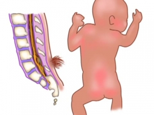 Rising Need for Spina Bifida In-Utero - Market in Developing Nations