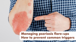 Managing psoriasis flare-ups | How to prevent common triggers