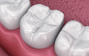 What Happens If Your Composite Filling Falls Out?