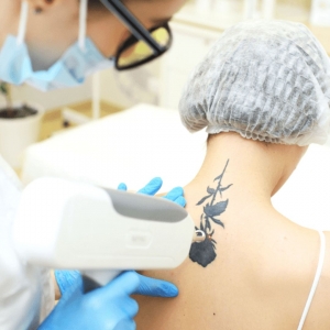 Winter Park Tattoo Removal