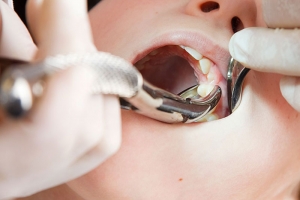Dental Extractions and Their Role in Orthodontic Treatment