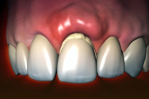 Abscess Treatment Market to Surpass US$ 2.3 Billion by 2030, Powered by Rising Prevalence of Abscesses