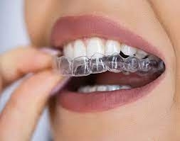 Protect Your Teeth During Sports with the Right Mouthguard