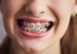 Braces, The Key to Achieving a Flawless Smile