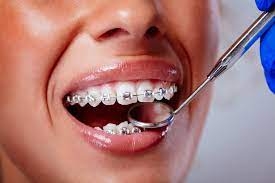 Straight Teeth, Classic Style, The Metal Braces Solution