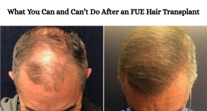 What You Can and Can’t Do After an FUE Hair Transplant
