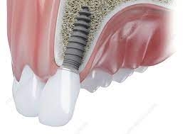 The Lifespan of Dental Implants, What You Need to Know