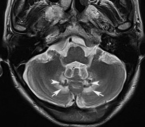 The Emerging Cerebrotendinous Xanthomatosis Market Poised to Grow at Highest Pace owing to Increasing Disease Awareness