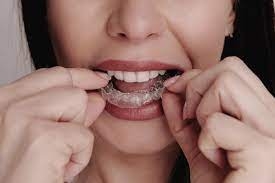 The Advantages of Clear Aligners for Your Teeth and Confidence