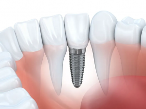 5 Key Factors That Make Same-Day Dental Implants a Smart Choice