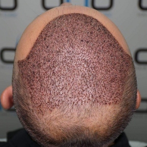 FUE Hair Transplant in Islamabad: The Most Advanced Technique Explained