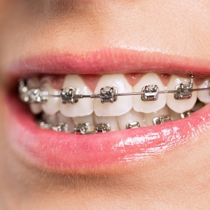 Advanced Orthodontics in Riyadh: The Latest Teeth Straightening Tech